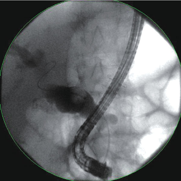 Endoscopy Treatment in Mumbai Endoscopic Surgery in Mumbai, India